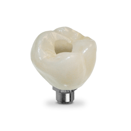 Screw-Retained Crown